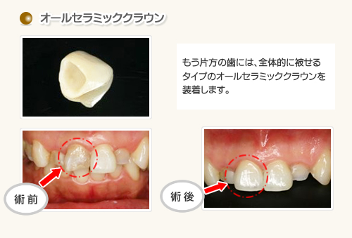 オールセラミッククラウン施術例