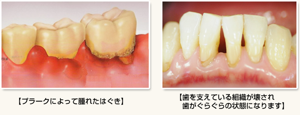 歯周病の症状