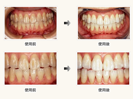 ホワイトニング 使用前使用後