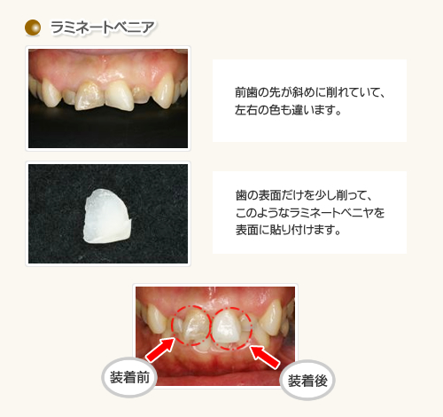 ラミネートベニア施術例